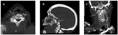 Case report: Tenecteplase for acute ischemic stroke after heparin reversal